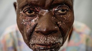 Christophe Chavilinga, 90 ans, atteint de la variole, attend d'être soigné dans une clinique de Munigi, dans l'est du Congo, le 16 août 2024 - Copyright © africanews Moses Sawasawa/Copyright 2024 The AP. All rights reserved